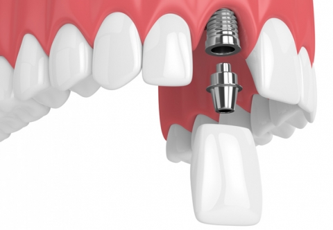 Cắm Implant răng cửa: Những điều cần biết trước khi thực hiện